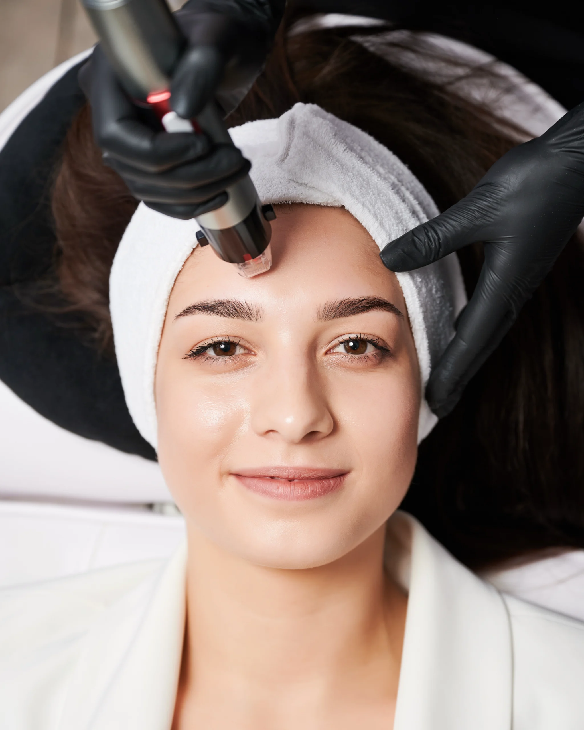Microneedling treatment